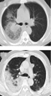 Clinical Features and Analysis of Two Patients with Novel Influenza H7N9 Virus in Taizhou City, China, 2014