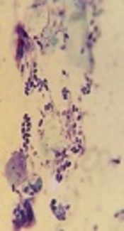 Treatment of Mixed Otitis Externa Using Ceftazidime Powder and Topical Miconazole Versus Topical Miconazole Only