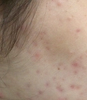 The Efficacy of a Herbal Syrup (Containing Plum, Jujube, Yellow Myrobalan, Golden Shower, Tamarind, Honey) in the Treatment of Mild to Moderate Acne Vulgaris: A Triple- Blinded Randomized Clinical Trial