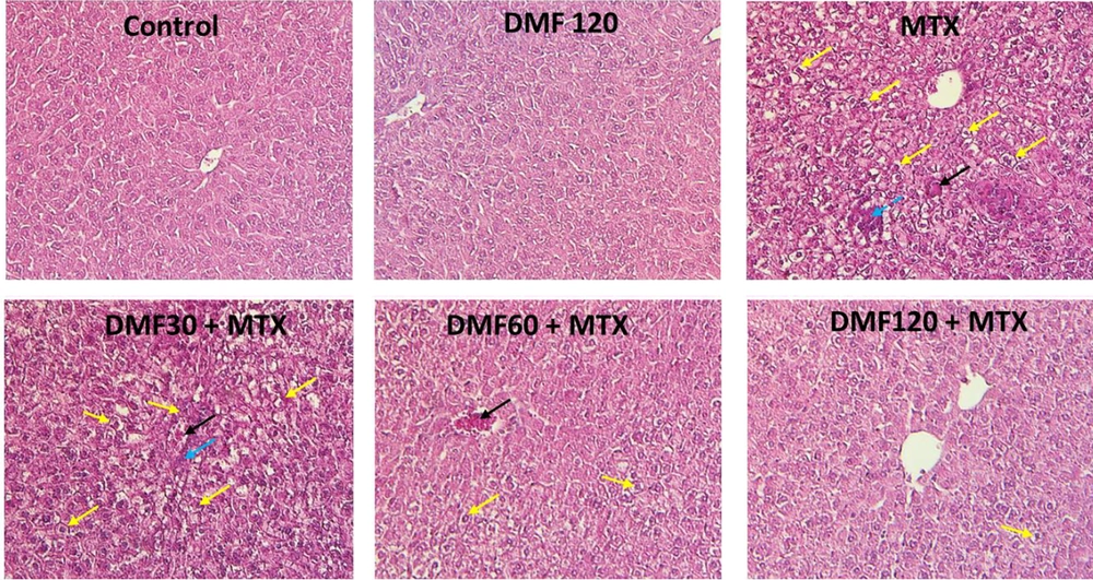 DMF (dimethyl fumarate) effects on MTX (methotrexate)-induced liver tissue changes (H&E × 250) in mice. Yellow arrows: Deposition of fat; blue arrows: Inflammatory cells’ infiltration; black arrows: Congestion of RBCs. The livers of MTX-injured mice showed inflammatory cells’ infiltration, fat deposition, and RBC accumulation. MTX-induced liver damage in DMF-treated mice was reduced as the dose increased from 30 to 120 mg/kg DMF (dimethyl fumarate) effects on MTX (methotrexate)-induced liver tissue changes (H&E × 250) in mice. Yellow arrows: Deposition of fat; blue arrows: Inflammatory cells’ infiltration; black arrows: Congestion of RBCs. The livers of MTX-injured mice showed inflammatory cells’ infiltration, fat deposition, and RBC accumulation. MTX-induced liver damage in DMF-treated mice was reduced as the dose increased from 30 to 120 mg/kg