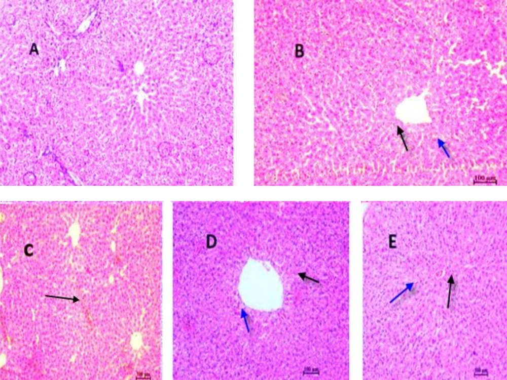 Histopathological evaluation of the effect of sildenafil and Vit E on CP-induced hepatotoxicity in rats. A, control group; B, CP (200 mg/kg) group; C, sildenafil (75 mg/kg) + CP group; D, sildenafil (75 mg/kg) + Vit E+ C group, E; CP + Vit E group. Haematoxylin and eosin-stained liver sections (H&E). (10×). A: Normal, B: Black arrow indicates a large amount of apoptosis and also a large increase of blood in the sinusoidal capillaries, C: Widening of sinusoidal capillaries and accumulation in them is observed, D: Closing of sinusoidal capillaries and black arrow indicates apoptosis and blue arrow indicates hepatocyte cell vesicle, E: Black arrow indicates apoptosis and blue arrow indicates hepatocyte cell vesicle. Histopathological evaluation of the effect of sildenafil and Vit E on CP-induced hepatotoxicity in rats. A, control group; B, CP (200 mg/kg) group; C, sildenafil (75 mg/kg) + CP group; D, sildenafil (75 mg/kg) + Vit E+ C group, E; CP + Vit E group. Haematoxylin and eosin-stained liver sections (H&E). (10×). A: Normal, B: Black arrow indicates a large amount of apoptosis and also a large increase of blood in the sinusoidal capillaries, C: Widening of sinusoidal capillaries and accumulation in them is observed, D: Closing of sinusoidal capillaries and black arrow indicates apoptosis and blue arrow indicates hepatocyte cell vesicle, E: Black arrow indicates apoptosis and blue arrow indicates hepatocyte cell vesicle.