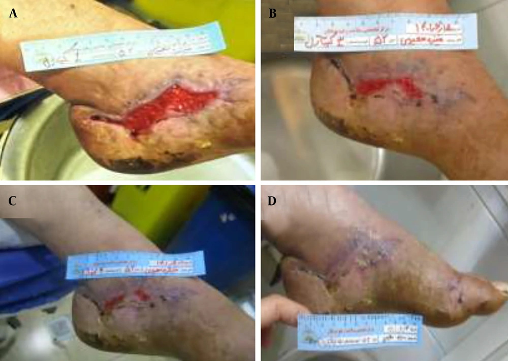 Clinical progression of wound healing in a diabetic male patient treated with Chitagel. A, Baseline wound presentation demonstrating an approximately 4 cm<sup>2</sup> ulcerative lesion with granulation tissue and inflammatory changes. B, Intermediate healing stage showing decreased wound size and improvement in tissue organization. C, Advanced healing stage demonstrating marked wound contraction and improved surface coverage. Clinical progression of wound healing in a diabetic male patient treated with Chitagel. A, Baseline wound presentation demonstrating an approximately 4 cm<sup>2</sup> ulcerative lesion with granulation tissue and inflammatory changes. B, Intermediate healing stage showing decreased wound size and improvement in tissue organization. C, Advanced healing stage demonstrating marked wound contraction and improved surface coverage.