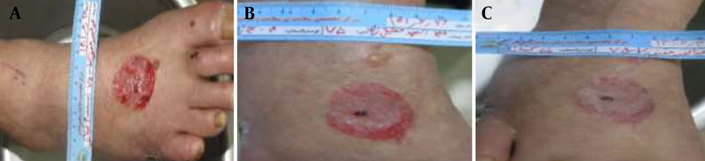 Sequential wound-healing progression in a 60-year-old diabetic patient treated with Chitagel. A, Baseline wound presentation showing an approximately 4 × 3 cm ulcer with a depth of 0.5 cm associated with granulation tissue and mild inflammation. B-C, Intermediate healing stages demonstrating reduced wound depth, improved tissue continuity, and decreased inflammatory signs. D, Late healing stage showing progressive surface coverage and reduced wound dimensions. E, Final healing stage demonstrating near-complete wound closure. Sequential wound-healing progression in a 60-year-old diabetic patient treated with Chitagel. A, Baseline wound presentation showing an approximately 4 × 3 cm ulcer with a depth of 0.5 cm associated with granulation tissue and mild inflammation. B-C, Intermediate healing stages demonstrating reduced wound depth, improved tissue continuity, and decreased inflammatory signs. D, Late healing stage showing progressive surface coverage and reduced wound dimensions. E, Final healing stage demonstrating near-complete wound closure.
