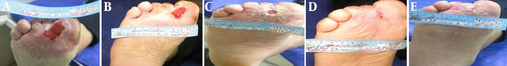 Clinical progression of diabetic wound healing in a 60-year-old patient treated with Chitagel. A, Baseline wound presentation demonstrating a 4 × 3 cm ulcerative lesion with irregular wound margins, inflammatory changes, and granulation tissue. B - C, Intermediate healing stages showing reduction in wound area and decreased inflammatory signs. D, Follow-up evaluation after three months demonstrating complete surface closure with minimal residual tissue disruption. Clinical progression of diabetic wound healing in a 60-year-old patient treated with Chitagel. A, Baseline wound presentation demonstrating a 4 × 3 cm ulcerative lesion with irregular wound margins, inflammatory changes, and granulation tissue. B - C, Intermediate healing stages showing reduction in wound area and decreased inflammatory signs. D, Follow-up evaluation after three months demonstrating complete surface closure with minimal residual tissue disruption.