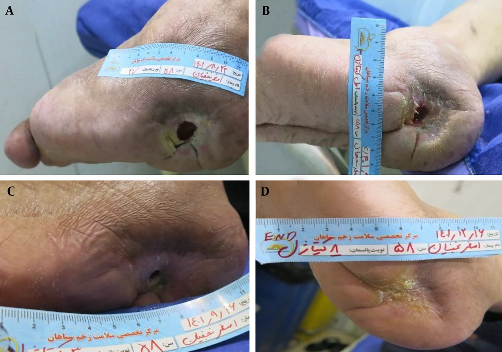 Sequential wound-healing progression in a 69-year-old diabetic female patient treated with Chitagel. A, Baseline wound presentation demonstrating a 2 × 2 cm ulcer with a depth of approximately 0.5 cm associated with exposed tissue and mild inflammation. B, Day 7 demonstrating reduced wound area and progressive surface coverage. C-D, Day 11 showing complete wound closure with re-established tissue continuity and minimal residual scarring. Sequential wound-healing progression in a 69-year-old diabetic female patient treated with Chitagel. A, Baseline wound presentation demonstrating a 2 × 2 cm ulcer with a depth of approximately 0.5 cm associated with exposed tissue and mild inflammation. B, Day 7 demonstrating reduced wound area and progressive surface coverage. C-D, Day 11 showing complete wound closure with re-established tissue continuity and minimal residual scarring.