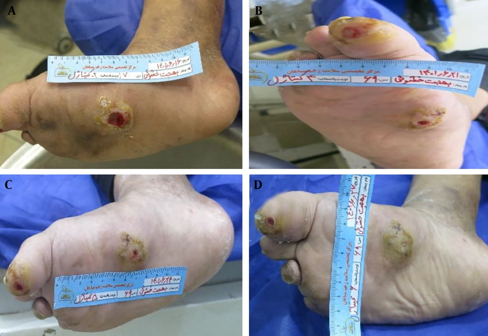 Clinical progression of wound healing in a 62-year-old diabetic female patient treated with Chitagel. A, Baseline wound presentation demonstrating an ulcerative lesion with an approximate depth of 1 cm associated with inflammation and exposed tissue. B, Day 7 demonstrating granulation tissue formation, reduction in inflammatory signs, and partial wound contraction. C, Day 14 showing complete wound closure and improved wound continuity with minimal residual scarring. Clinical progression of wound healing in a 62-year-old diabetic female patient treated with Chitagel. A, Baseline wound presentation demonstrating an ulcerative lesion with an approximate depth of 1 cm associated with inflammation and exposed tissue. B, Day 7 demonstrating granulation tissue formation, reduction in inflammatory signs, and partial wound contraction. C, Day 14 showing complete wound closure and improved wound continuity with minimal residual scarring.