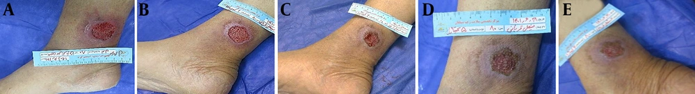 Clinical progression of wound healing in an 80-year-old male patient with a chronic non-healing wound treated with Chitagel. A, Baseline wound presentation demonstrating an approximately 4 × 3 cm ulcerative lesion with granulation tissue, inflammatory changes, and irregular wound margins. B, Day 10 demonstrating reduction in wound dimensions, improved tissue continuity, and decreased inflammatory signs. C - D, Day 16 showing complete wound closure with minimal residual scarring. Clinical progression of wound healing in an 80-year-old male patient with a chronic non-healing wound treated with Chitagel. A, Baseline wound presentation demonstrating an approximately 4 × 3 cm ulcerative lesion with granulation tissue, inflammatory changes, and irregular wound margins. B, Day 10 demonstrating reduction in wound dimensions, improved tissue continuity, and decreased inflammatory signs. C - D, Day 16 showing complete wound closure with minimal residual scarring.