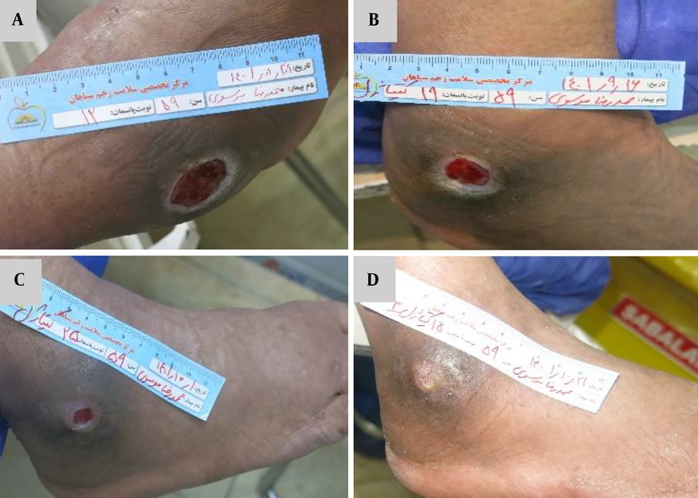 Sequential clinical evaluation of wound healing in a 59-year-old male patient with a chronic non-healing wound treated with Chitagel. A, Baseline wound presentation demonstrating an approximately 4 × 4 cm ulcerative lesion with a depth of 0.5 cm associated with chronic inflammatory changes and irregular wound margins. B, Day 10 showing wound contraction and decreased inflammatory signs. C, Day 40 demonstrating further wound contraction with near-complete surface coverage. D, Day 54 showing complete wound closure with minimal residual scarring. Sequential clinical evaluation of wound healing in a 59-year-old male patient with a chronic non-healing wound treated with Chitagel. A, Baseline wound presentation demonstrating an approximately 4 × 4 cm ulcerative lesion with a depth of 0.5 cm associated with chronic inflammatory changes and irregular wound margins. B, Day 10 showing wound contraction and decreased inflammatory signs. C, Day 40 demonstrating further wound contraction with near-complete surface coverage. D, Day 54 showing complete wound closure with minimal residual scarring.