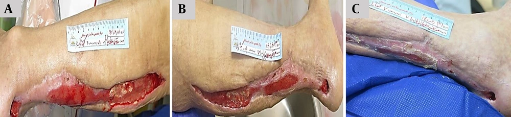 Sequential clinical evaluation of post-surgical wound healing in a 71-year-old male patient treated with Chitagel. A, Baseline wound presentation demonstrating an approximately 22 × 5 cm post-surgical wound with a depth of 2 cm associated with exposed tissue surfaces and mild exudate. B, Day 10 demonstrating decreased wound size to approximately 18 × 3 cm with a depth of 1 cm, accompanied by decreased exudation and tissue approximation. C, Day 14 showing further wound reduction to approximately 10 × 1 cm with a depth of 0.7 cm and improved wound continuity. Sequential clinical evaluation of post-surgical wound healing in a 71-year-old male patient treated with Chitagel. A, Baseline wound presentation demonstrating an approximately 22 × 5 cm post-surgical wound with a depth of 2 cm associated with exposed tissue surfaces and mild exudate. B, Day 10 demonstrating decreased wound size to approximately 18 × 3 cm with a depth of 1 cm, accompanied by decreased exudation and tissue approximation. C, Day 14 showing further wound reduction to approximately 10 × 1 cm with a depth of 0.7 cm and improved wound continuity.