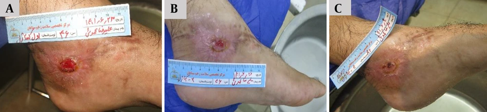 Sequential clinical evaluation of post-surgical wound healing in a 46-year-old male patient treated with Chitagel. A, Baseline wound presentation demonstrating an approximately 2 × 2 cm surgical wound with visible granulation tissue, moderate inflammatory changes, and irregular wound margins. B, Day 4 demonstrating reduced wound area and decreased inflammatory signs. C, Day 7 showing complete wound closure with improved surface continuity and minimal residual scarring. Sequential clinical evaluation of post-surgical wound healing in a 46-year-old male patient treated with Chitagel. A, Baseline wound presentation demonstrating an approximately 2 × 2 cm surgical wound with visible granulation tissue, moderate inflammatory changes, and irregular wound margins. B, Day 4 demonstrating reduced wound area and decreased inflammatory signs. C, Day 7 showing complete wound closure with improved surface continuity and minimal residual scarring.