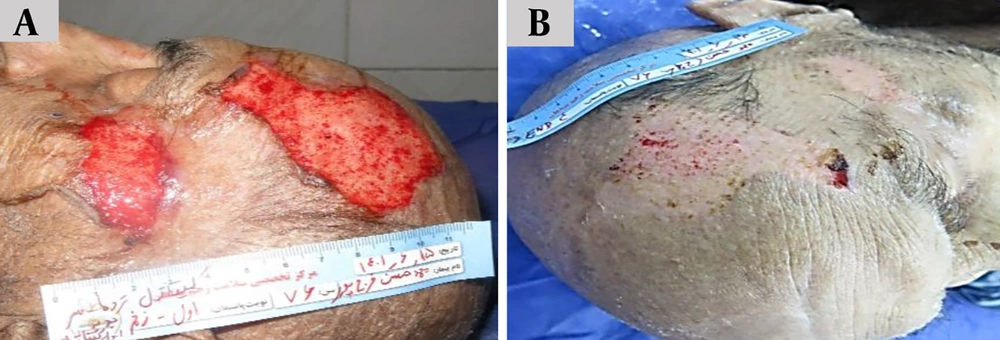 Sequential clinical evaluation of traumatic wound healing in a 76-year-old male patient with severe head trauma treated with Chitagel. A, Baseline wound presentation demonstrating extensive soft-tissue injury with exposed tissue surfaces, active bleeding, and severe disruption of skin continuity. B, Follow-up evaluation demonstrating progressive wound closure and improved tissue continuity, with complete surface healing observed within 8 days of treatment. Sequential clinical evaluation of traumatic wound healing in a 76-year-old male patient with severe head trauma treated with Chitagel. A, Baseline wound presentation demonstrating extensive soft-tissue injury with exposed tissue surfaces, active bleeding, and severe disruption of skin continuity. B, Follow-up evaluation demonstrating progressive wound closure and improved tissue continuity, with complete surface healing observed within 8 days of treatment.