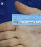Clinical Evaluation of Chitagel in Chronic Wound Healing: A Complementary Bioactive Gel with Echinacea Extract and Quaternary Ammonium-Modified Chitosan