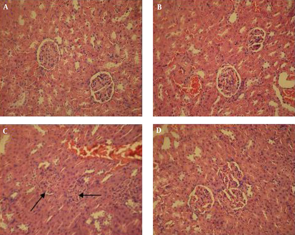 Histological Sections of the Kidney from Different Studied Groups A, healthys control; B, healthy controls treated with extract; C, untreated diabetic; D, diabetic treated with the extract. Tubules and glomeruli were normal in control rats (untreated and treated with hydro-alcoholic extract). The kidney of diabetic rats represents degenerated glomeruli and reduced urinary space (arrows), but these changes were ameliorated in the diabetic rats treated with hydro-alcoholic extract (H and E X300).