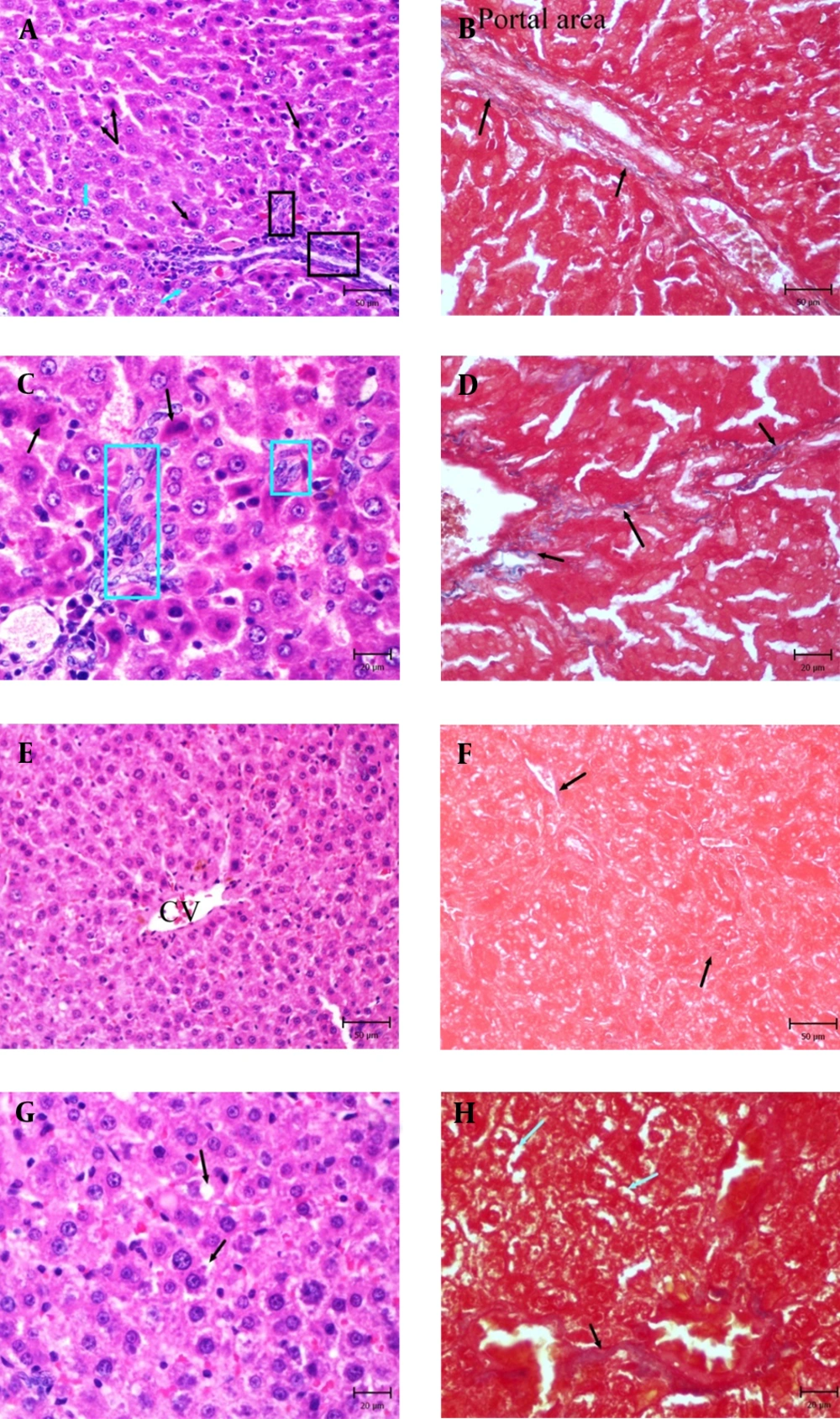 Photomicrographs of Liver in DEN and DEN + EPE Experimental Groups <b>A.</b> DEN group, note to proliferation of hepatic stellate cells (Square), necrotic hepatocytes (Black arrows) and hepatocytes with enlarged nuclei (Karyomegali) (Blue arrows) (H & E, Bar: 50µm). <b>B.</b> DEN group, note to blue fibers around portal area (MT staining, Bar: 50 µm). <b>C.</b> Part of picture A with high magnification, proliferated stellate cells is obvious (Blue square) (H & E, Bar: 20 µm). <b>D.</b> Part of picture C, note to increased blue fibers (MT staining, Bar: 50 µm). <b>E.</b> DEN + EPE group, note to retained Architecture of liver (H & E, Bar: 50 µm). <b>F.</b> DEN + EPE group, normal rate of Blue materials (MT Staining, Bar: 50 µm). <b>G.</b> Part of picture E, note to cell swelling (Black arrows) in hepatocytes (H & E, Bar: 20 µm). <b>H.</b> Part of picture F, cell swelling in hepatocytes (Blue arrows) and blue fibers (Black arrows) are obvious (MT staining, Bar: 20 µm).