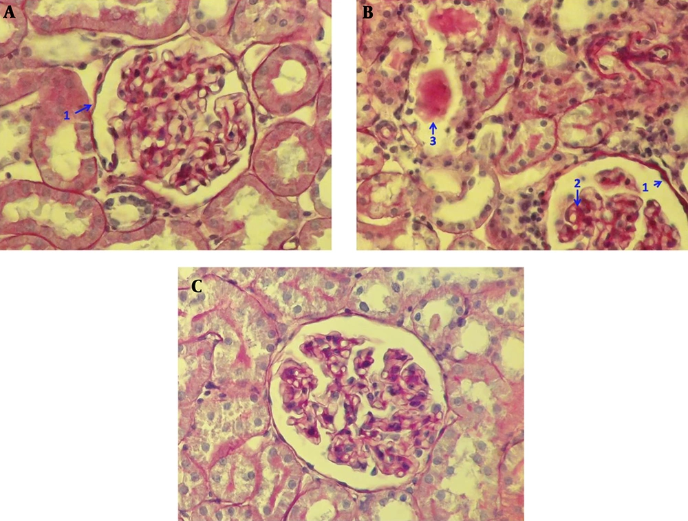 Photomicrograph of kidney section in studied groups PAS (40X); sham group (A) without glomerular and tubular injury such as glomerular basement membrane being thin (1), no deposition of glomerular mesangial matrix with normal glomerular size and normal Tubular lumen and epithelial cells. Ovareictomy group (B) with moderate glomerular and tubular injury such as glomerular basement membrane being partially thickened (1), regionally increased glomerular mesangial matrix accumulation regionally (2) with glomerular hypertrophy. and high amount of tubular casts (3) OVX + genstein group (C) without glomerular and tubular injury such as glomerular basement membrane being thin, no deposition of glomerular mesangial matrix with normal glomerular size. and normal tubular lumen and epithelial cells Photomicrograph of kidney section in studied groups PAS (40X); sham group (A) without glomerular and tubular injury such as glomerular basement membrane being thin (1), no deposition of glomerular mesangial matrix with normal glomerular size and normal Tubular lumen and epithelial cells. Ovareictomy group (B) with moderate glomerular and tubular injury such as glomerular basement membrane being partially thickened (1), regionally increased glomerular mesangial matrix accumulation regionally (2) with glomerular hypertrophy. and high amount of tubular casts (3) OVX + genstein group (C) without glomerular and tubular injury such as glomerular basement membrane being thin, no deposition of glomerular mesangial matrix with normal glomerular size. and normal tubular lumen and epithelial cells