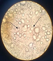 Formulation of Triple Cream for Treatment of Melasma