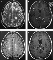 Cover image of the article: Management of High Disease Activity in Multiple Sclerosis Using ZytuxTM (Rituximab, AryoGen Pharmed): Evidence from a Case Report