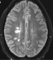 A 25-Year-Old Clinically Isolated Syndrome Patient with Tumefactive Demyelinating Lesion in Cervical Cord: A Case Report and a Mini Review
