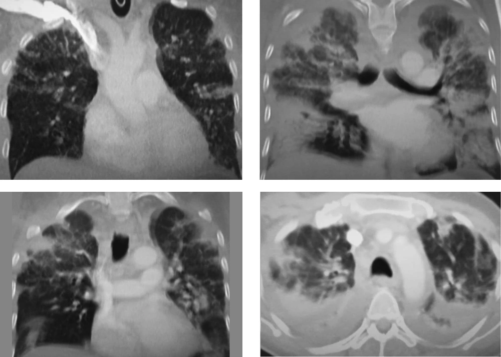 An axial CT image obtained without intravenous contrast in a 51-year-old male in the “late” time 19 December 2019 (8 days from symptom onset to this CT) shows severe Ground-glass opacification and consolidation in right and left lower and upper lobe. An axial CT image obtained without intravenous contrast in a 51-year-old male in the “late” time 19 December 2019 (8 days from symptom onset to this CT) shows severe Ground-glass opacification and consolidation in right and left lower and upper lobe.