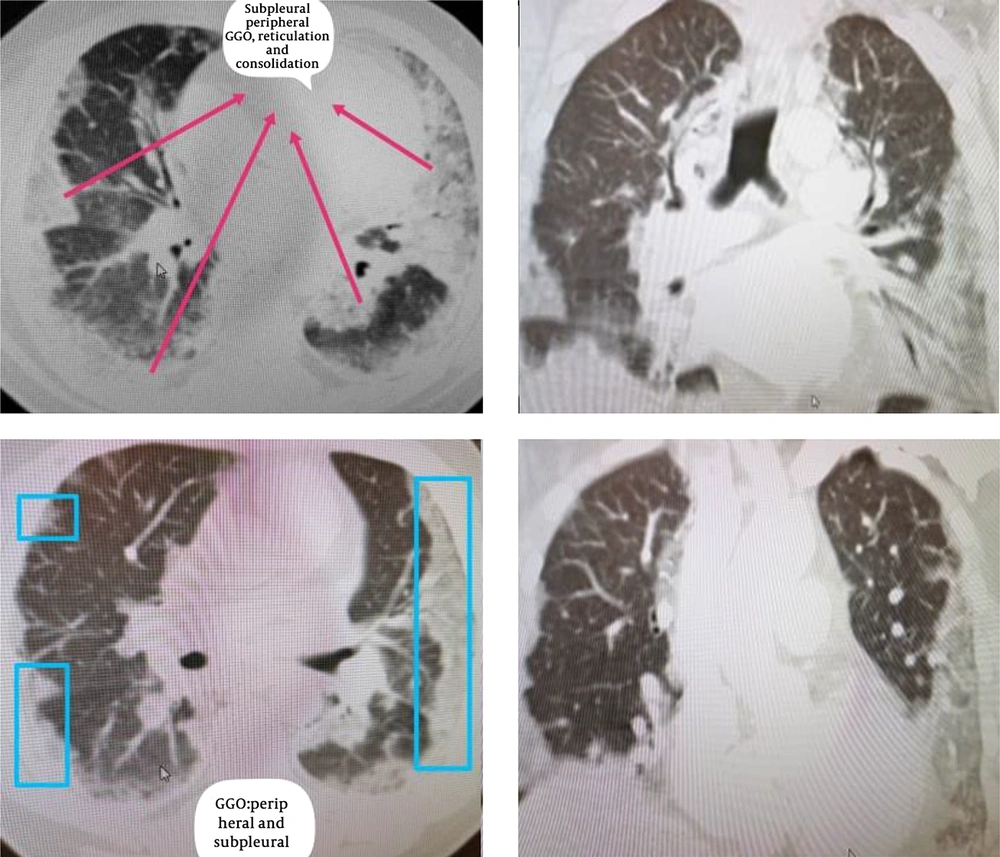 An axial CT image obtained without intravenous contrast in a 49-year-old male in the “late” time 23 December 2019 (10 days from symptom onset to this CT) shows bilateral reticulations and patchy consolidations opacities, with a striking subpleural peripheral distribution, subpleural lower lobe predominant Ground glass opacities. An axial CT image obtained without intravenous contrast in a 49-year-old male in the “late” time 23 December 2019 (10 days from symptom onset to this CT) shows bilateral reticulations and patchy consolidations opacities, with a striking subpleural peripheral distribution, subpleural lower lobe predominant Ground glass opacities.