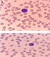 Hematological and Morphological Changes in the Peripheral Blood Smear of Patients with COVID-19