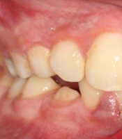Management of a Multiple Dentoalveolar Trauma in Permanent Teeth: A Case Report with an 18-Month Follow-up