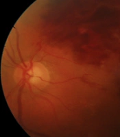 Branch Retinal Vein Occlusion Occurring After Second Dose of Sinopharm COVID-19 Vaccine: A Case Report