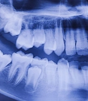 Surgical Repositioning Following a Severe Traumatic Intrusion of Maxillary Permanent Incisors: A Case Report