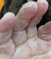 Rendú Osler Weber Syndrome or Hereditary Hemorrhagic Telangiectasia: A Case Report from Iran