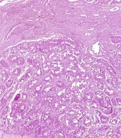 Testicular Torsion Following MMR Vaccination in an 18-Month-old Infant: A Case Report