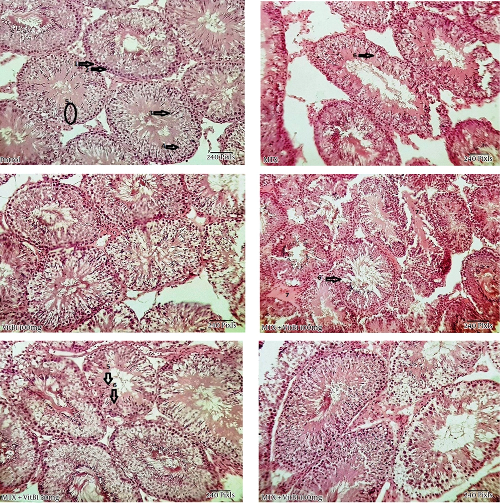 Study of histomorphometric changes in testicular tissue. Control, healthy group; MTX, methotrexate receiving group, indicated the lower epithelium thickness and germinal epithelium disjunction, VitB1 100 mg/kg; Positive control group, receiving only VitB1, the same as the control group, MTX/VitB1/25 mg/kg, MTX/VitB1/50 mg/kg, MTX/VitB1/100 mg/kg groups, show amelioration VitB1 dose-dependent. Hematoxylin and eosin staining, magnification ×100. (1) Spermatogonia, (2) primary spermatocyte, (3) spermatozoid, (4) spermatid, (5) accumulation of sperm on apical region of Sertoli cell, indicating the active Sertoli cell, (6) germinal epithelium disjunction, and (7) edema. Study of histomorphometric changes in testicular tissue. Control, healthy group; MTX, methotrexate receiving group, indicated the lower epithelium thickness and germinal epithelium disjunction, VitB1 100 mg/kg; Positive control group, receiving only VitB1, the same as the control group, MTX/VitB1/25 mg/kg, MTX/VitB1/50 mg/kg, MTX/VitB1/100 mg/kg groups, show amelioration VitB1 dose-dependent. Hematoxylin and eosin staining, magnification ×100. (1) Spermatogonia, (2) primary spermatocyte, (3) spermatozoid, (4) spermatid, (5) accumulation of sperm on apical region of Sertoli cell, indicating the active Sertoli cell, (6) germinal epithelium disjunction, and (7) edema.