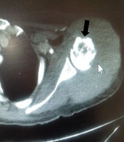 Possible Recurrence of Synovial Sarcoma Involving the Shoulder of a 57-Year-Old Female: A Rare Case Report from Iran