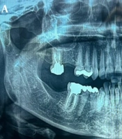 Anterior Mandibular Mural Unicystic Ameloblastoma Crossing the Midline: A Rare Case with Histopathological Diagnostic Challenges