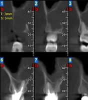 Recurrent Extensive Bilateral Central Giant Cell Granuloma of the Maxilla: A Case Report