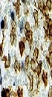 Is CD163 - A Marker of Progression in Osteoarthritis?