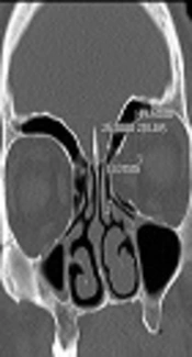 Dehiscence of Lamina Papyracea a Normal Variation: A Case Report in Iran