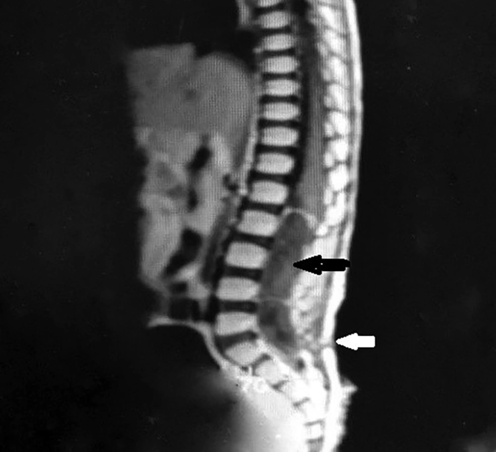 The MR imaging of the lumbo-sacral spine showed an intradural and extramedullary mass located between L2 and s2 levels with a sinus tract at level of S1 The MR imaging of the lumbo-sacral spine showed an intradural and extramedullary mass located between L2 and s2 levels with a sinus tract at level of S1