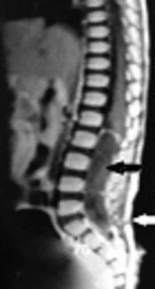 The First Presentation of the Spinal Dermoid Cyst with Recurrent Meningitis