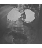 Atypical Morgagni Hernia: A Case Study Report