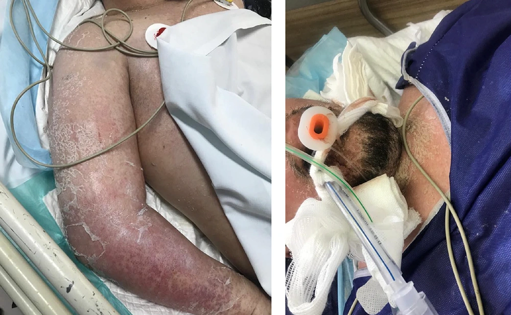 Atypical Presentation of Lamotrigine Induced DRESS Syndrome: A Case Report  and Review of the Literature