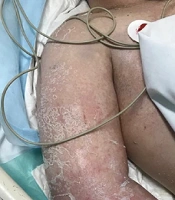 Atypical Presentation of Lamotrigine Induced DRESS Syndrome: A Case Report and Review of the Literature