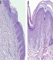 Cover image of the article: Treatment of Circumscribed Juvenile Type of Pityriasis Rubra Pilaris with Calcipotriol: A Case Report