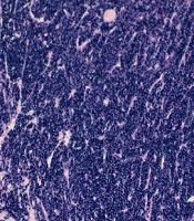Cover image of the article: Cutaneous Plasmacytoma: A Case Report
