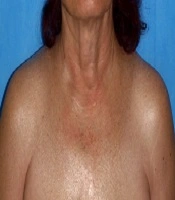 Dermatoses Associated with Diabetes Mellitus