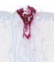 Cover image of the article: Proteomic Analysis Reveals an Increase of Neutrophils and TH17-related Proteins Expression in Severe Nodular Acne Lesions of the Back