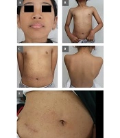 Cover image of the article: Primary Anetoderma in an Infant: A Case Report From Southeast Asia