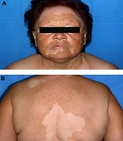 Probable Multiple Autoimmune Syndrome in a Patient with Vitiligo, Autoimmune Thyroiditis, and Diabetes Mellitus: A Case Report