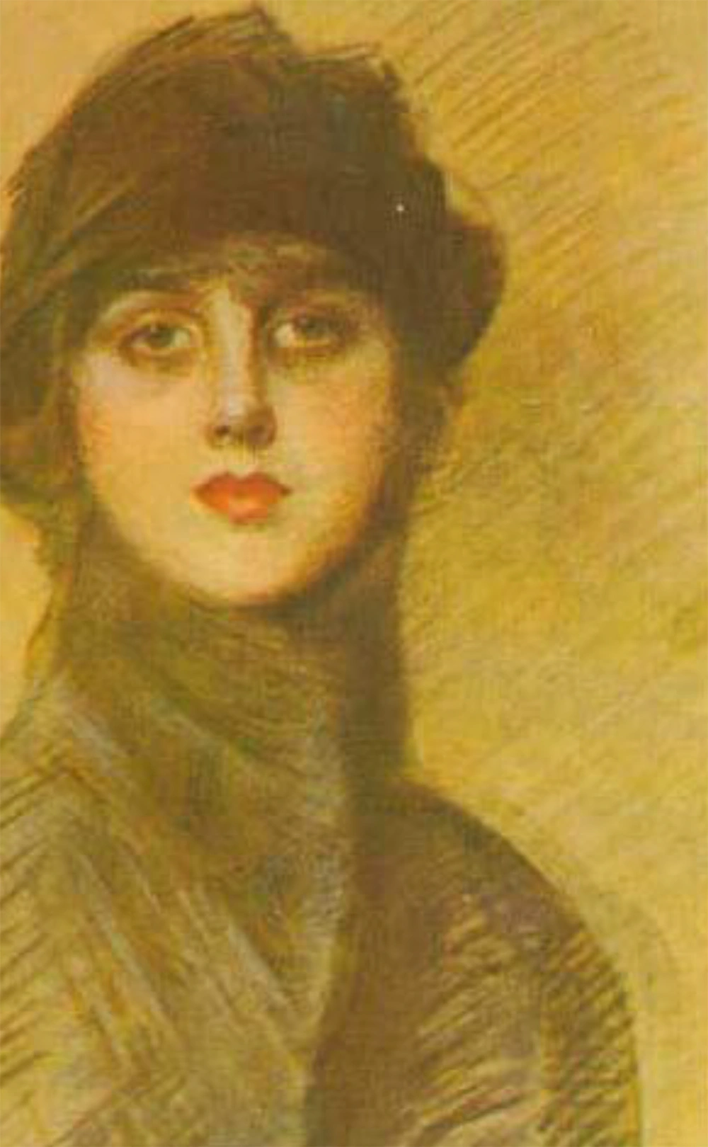 Portrait of Gladys Marie Spencer Churchill, Duchess of Marlborough; the most notable victim of paraffinoma syndrome Portrait of Gladys Marie Spencer Churchill, Duchess of Marlborough; the most notable victim of paraffinoma syndrome