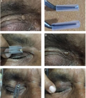 Cover image of the article: Surgical Pearl: Dissecting Forceps with Polytube for Periorbital Senile Comedone Extraction