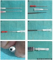Surgical Pearl: Disposable Hypodermic Needle Punch